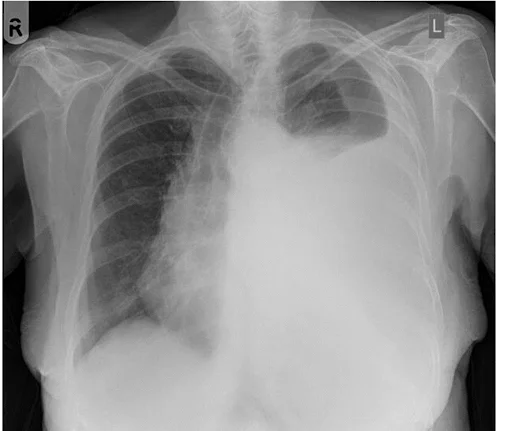 Exudative pleural effusion
