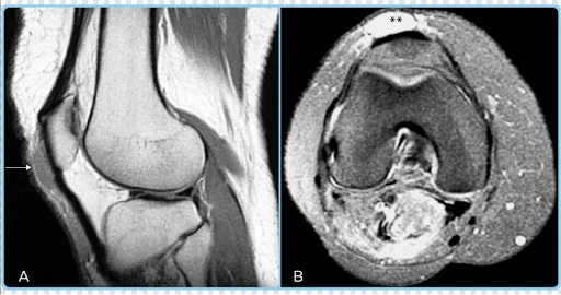 Housemaid's knee