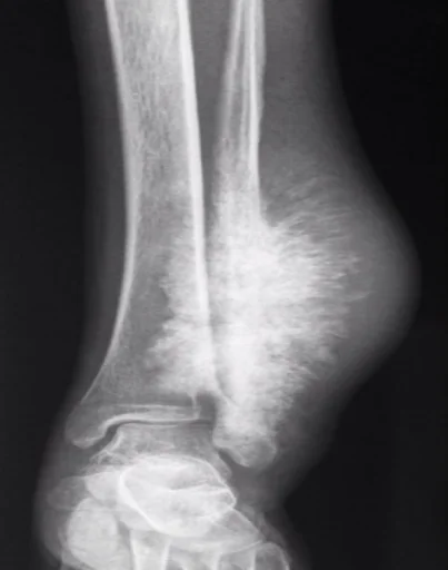 Osteosarcoma