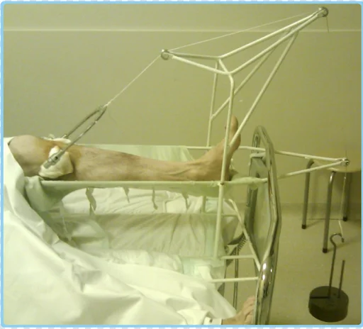 Bohler braun splint

