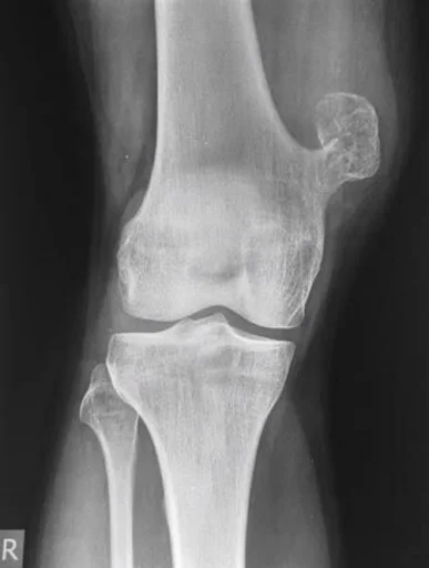 Osteochondroma

