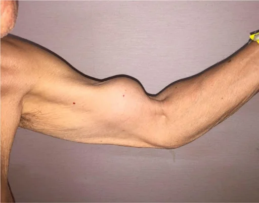 Biceps tendon rupture
