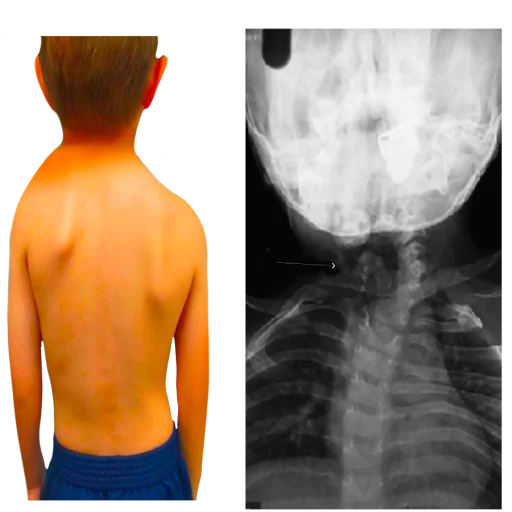 Klippel-Feil deformity
