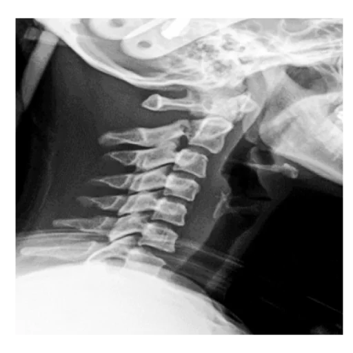 Hangman fracture
