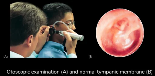 Otoscopic Examination
