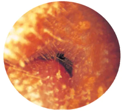 Furuncle of the Right External Auditory Canal
