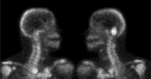 Technetium 99M Bone Scan

