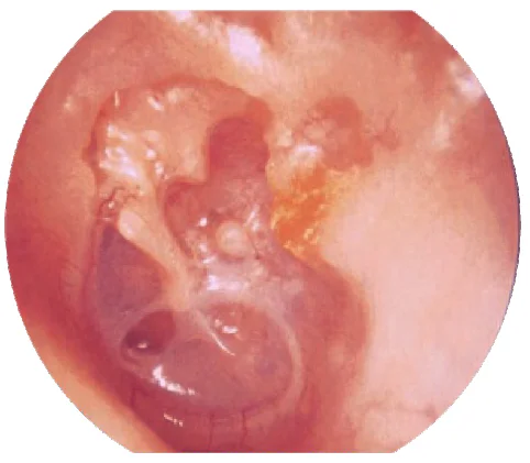 Open Mastoid Cavities
