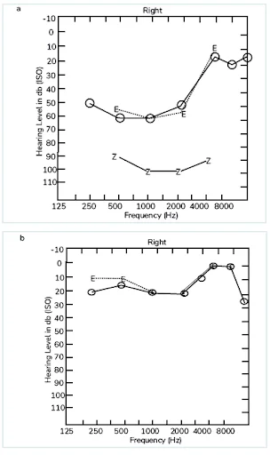 Audiogram In Meniere's Disease