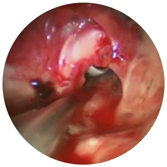 Endoscopic and Computed Tomographic Appearances of Cricotracheal Separation