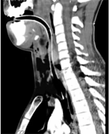 Endoscopic and Computed Tomographic Appearances of Cricotracheal Separations