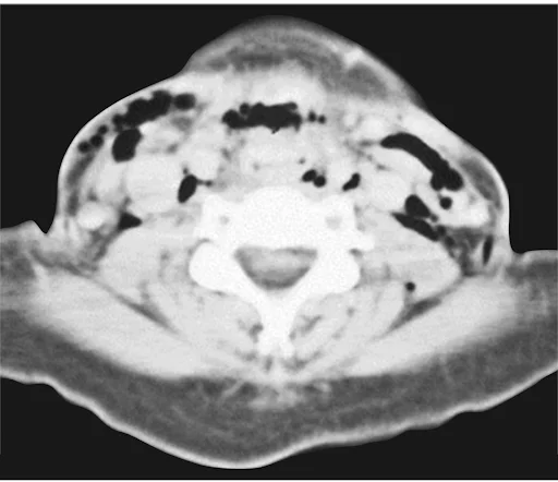 Subcutaneous Emphysema