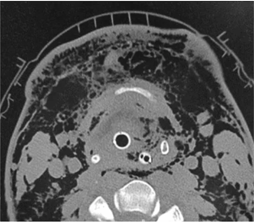 Subcutaneous Emphysema