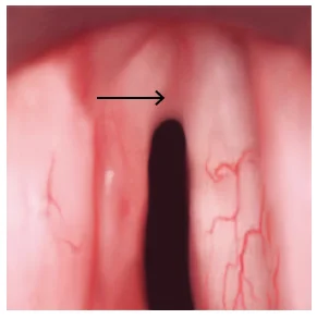 Anterior Glottic Web