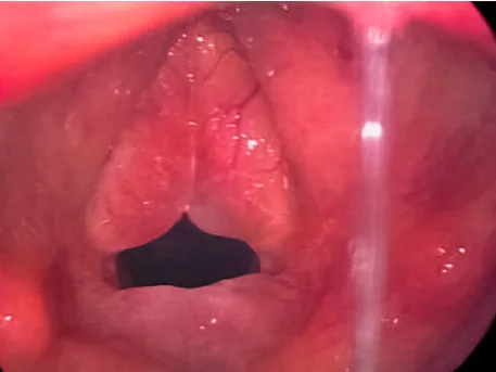 Reinke's Oedema