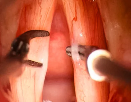 Vocal Sulcus