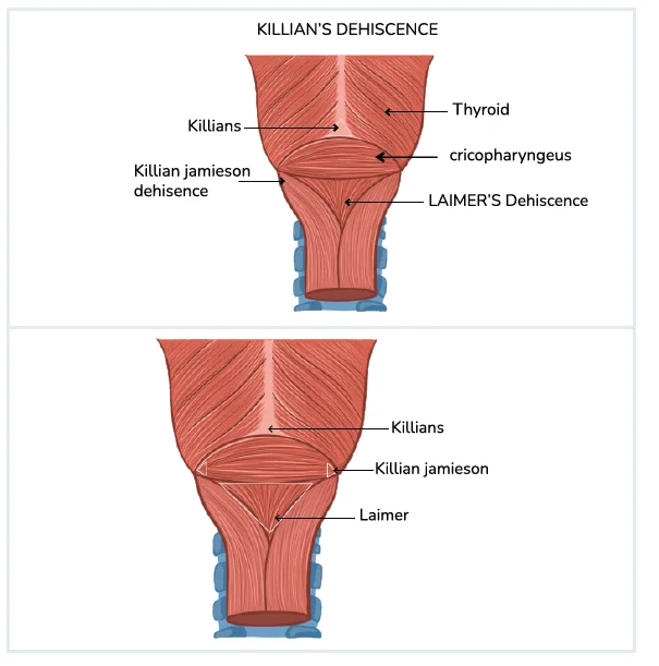 Killian's Dehiscence