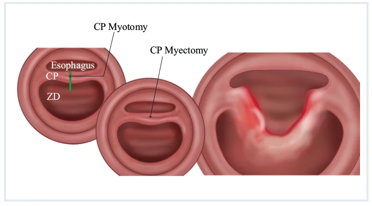 Cricopharyngeal Myotomy