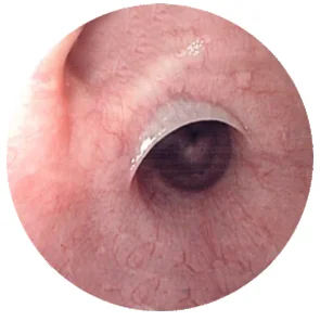 Plummer Vinson Syndrome