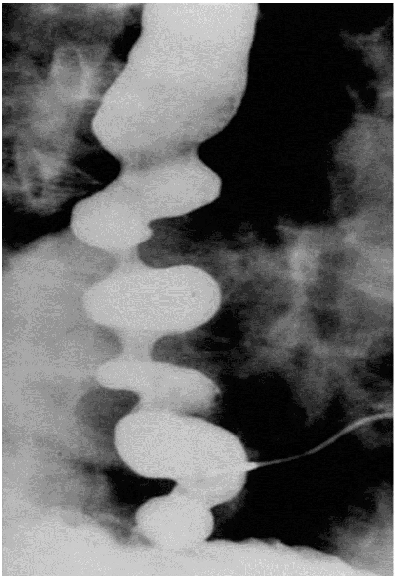 Diffuse Esophageal Spasm
