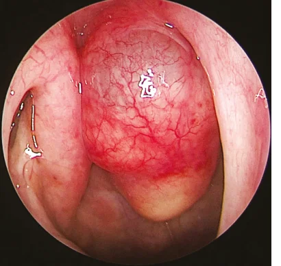Thornwaldt's Cyst/Bursa
