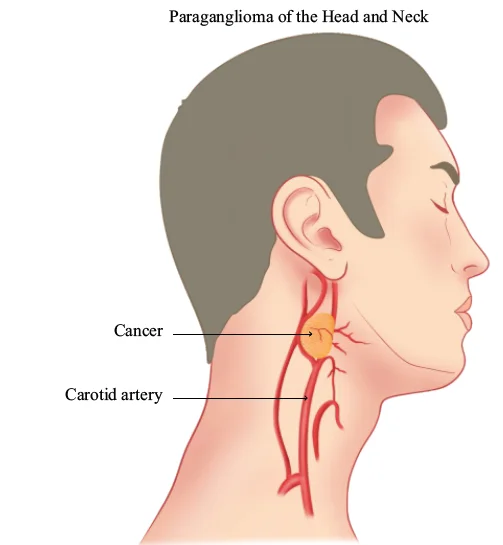 Paraganglioma