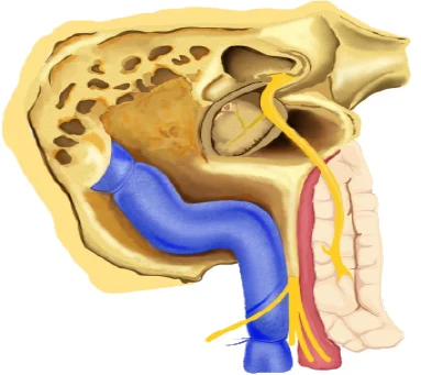 Facial Nerve Transposition in Ear Canal Wall Down