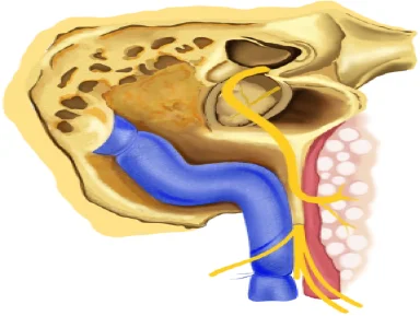 Facial Nerve Transposition in Ear Canal Wall Down