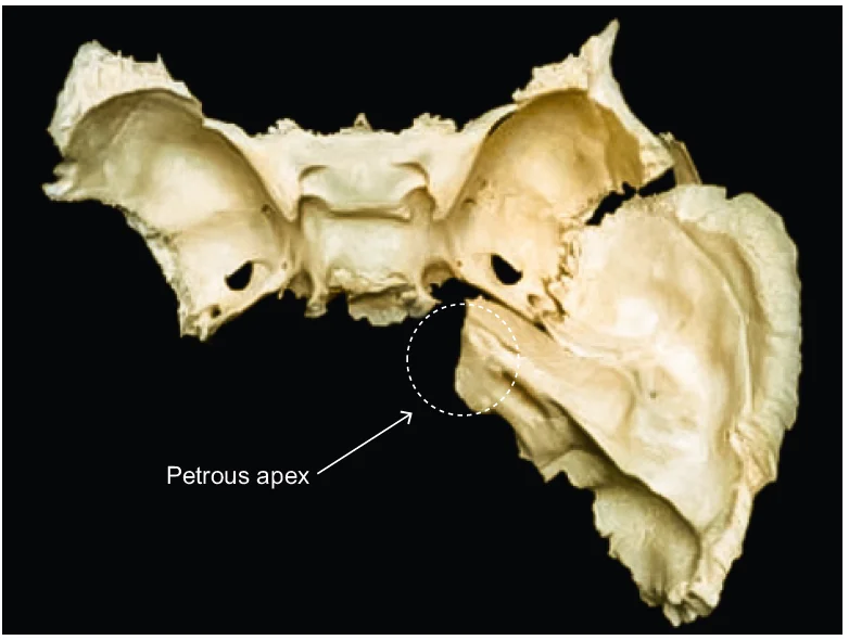 Petrous Apex Lesions