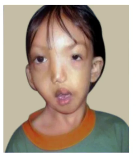 Moebius Syndrome