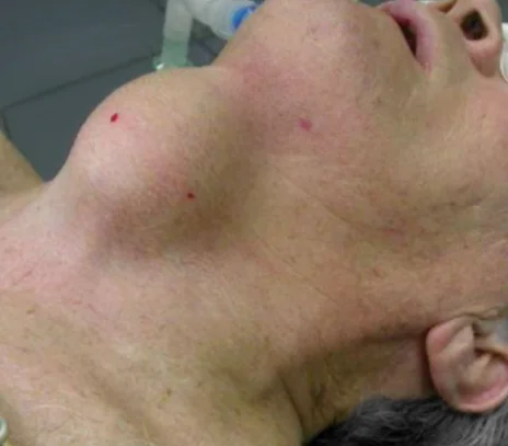 Thyroglossal Duct Cysts