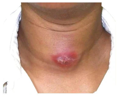 Tuberculous Adenitis
