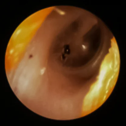 Ear Foreign Bodies