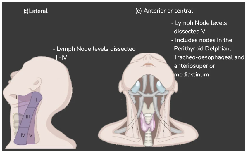 Antero Lateral Neck Dissection

