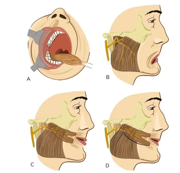 Masseter Transfer Procedure