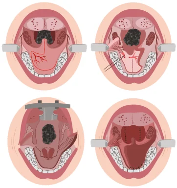 Procedure of Transoral Robotic Surgery (TORS) in ENT