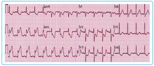ECG Interpretation (Myocardial Infarction)
