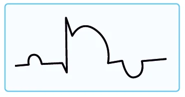 ST elevation