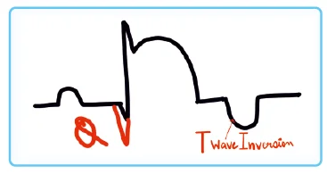 Q waves/ Pathological Q waves