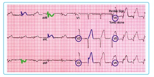 Tombstone Pattern/ Pardee sign ECG