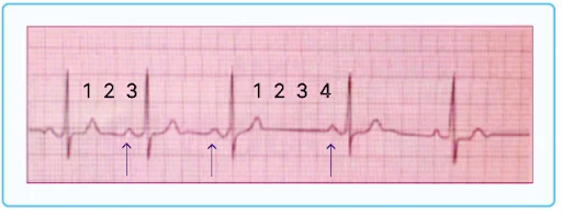 Sinus Arrhythmia ECG.