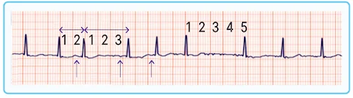 Atrial Fibrillation ECG