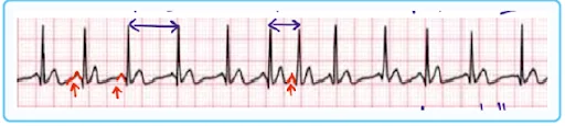 Multi-Focal Atrial Tachycardia ECG