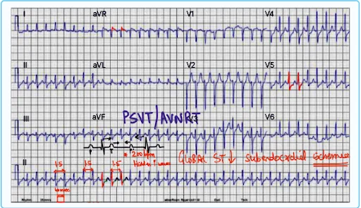 Paroxysmal Supraventricular Tachycardia ECG 