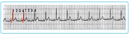 Wolf Parkinson White (WPW) Syndrome

