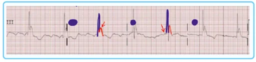 Hypothermia ECG findings
