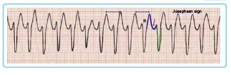 Ventricular Tachycardia ECG findings