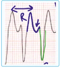 Ventricular Tachycardia ECG findingss