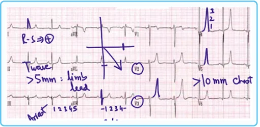 Hyperkalaemia ECG Findings