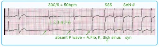Bradyarrhythmias ECG findings 